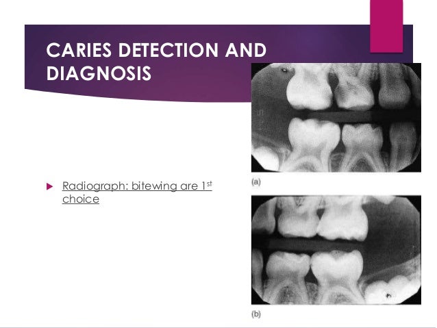 diagnosis of dental caries ppt